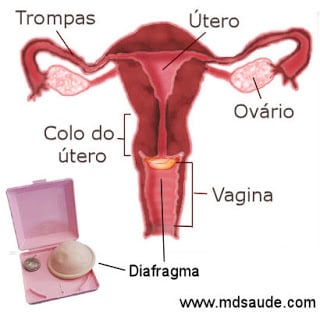 Método anticoncepcional: diafragma