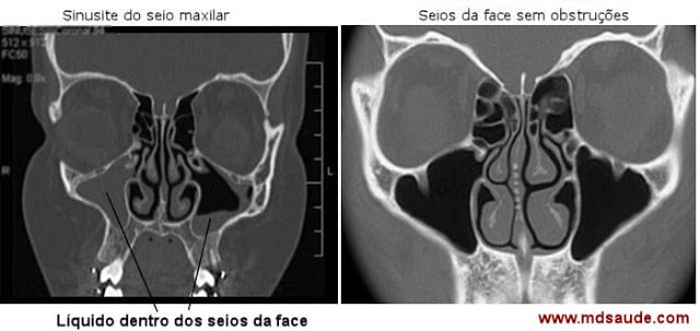 Sinusite na tomografia computadorizada