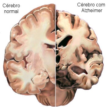 Comparação de um cérebro de um paciente com Alzheimer e um paciente sem Alzheimer