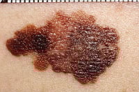 Melanoma