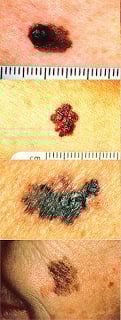 Melanoma