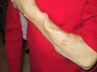 Fístula arteriovenosa de hemodiálise