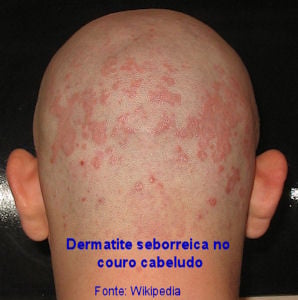 Dermatite seborreica