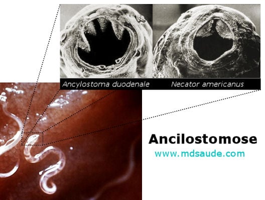 Ancilostomose