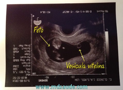 Ultrassom na gravidez: feto e vesícula vitelina