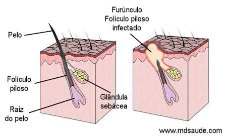 Furúnculo