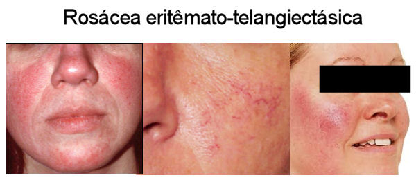 Tratamento da rosácea – Dra. Denise Santana