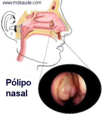 Pólipo nasal