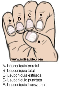Tipos de leuconíquia