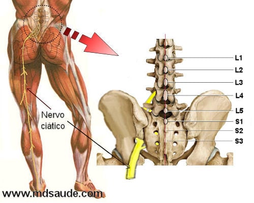 Como identificar se sua dor na perna é causada por um problema na coluna