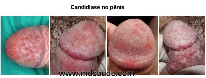 Candidiasis bij mannen