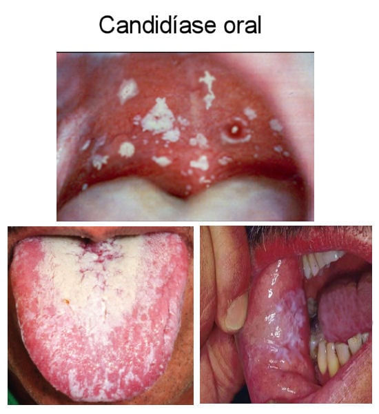 Fotos de Candidíase oral