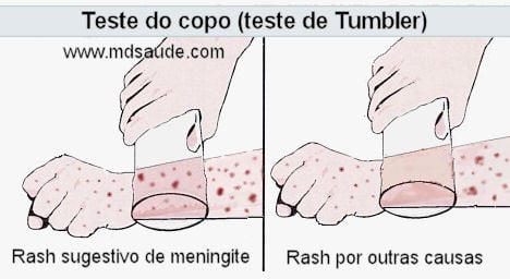 Sintomas meningite