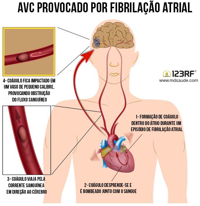 AVC - Fibrilação atrial