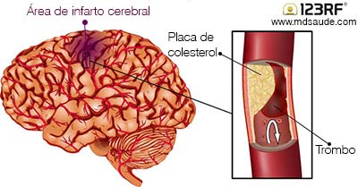 AVC isquêmico