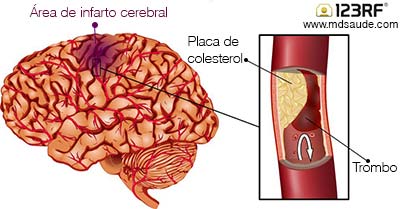 É hora de correr! Conheça os sinais do infarto e do AVC