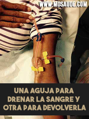 aguja de hemodiálisis