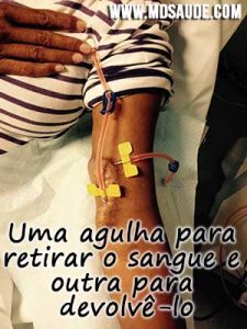 Fístula artério-venosa