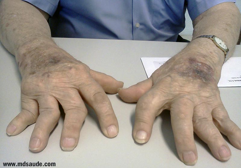 Desvio lateral com deformidades nas articulações dos dedos