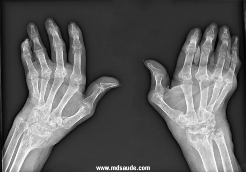 Desvio ulnar visto à radiografia
