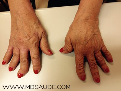 Artrite reumatoide nas mãos