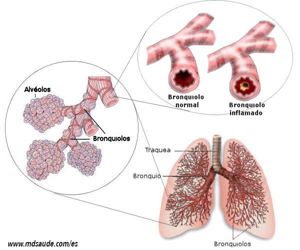 Asma bronquial