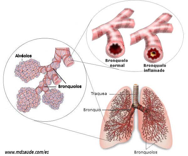 Asma Bronquial Sintomas Diagnostico Y Tratamiento Md Saude