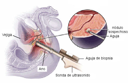 Biopsia de próstata