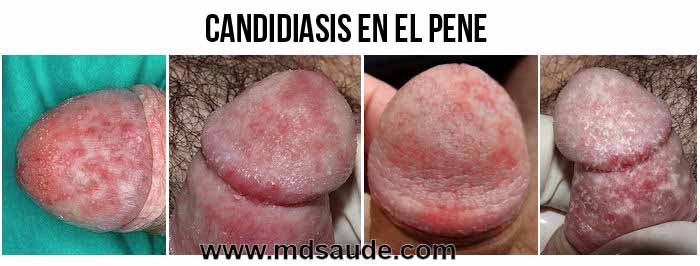 Candidiasis en los hombres