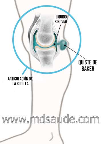 Quiste de Baker