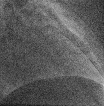 Animación de una coronariografía que muestra la inyección de contraste yodado a través de un catéter y su avance por las arterias coronarias, que se vuelven visibles en las imágenes de rayos X.