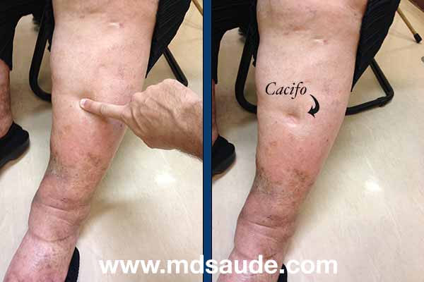 Edema com sinal de Godet