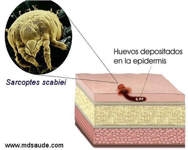 Sarna humana (escabiosis): síntomas y tratamiento