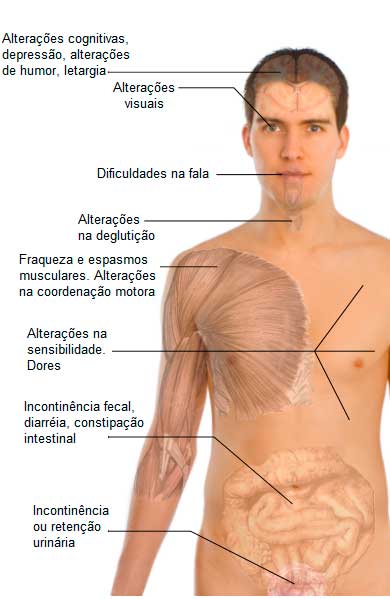 Sintomas da esclerose múltipla