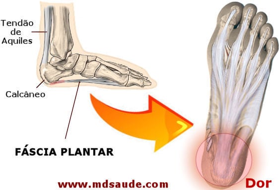 Inflamação da fáscia plantar.