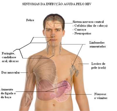HIV Sintomas