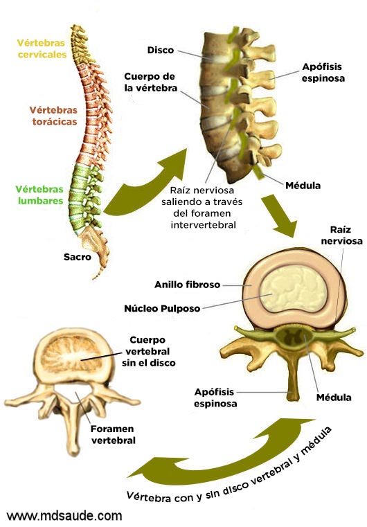 Hernia de disco