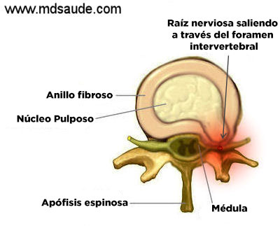 Hernia discal