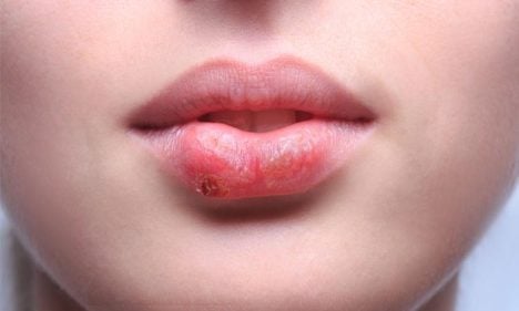 Herpes labial: contagio, síntomas y tratamiento