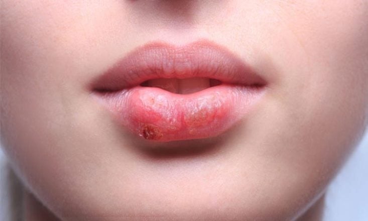 Herpes labial