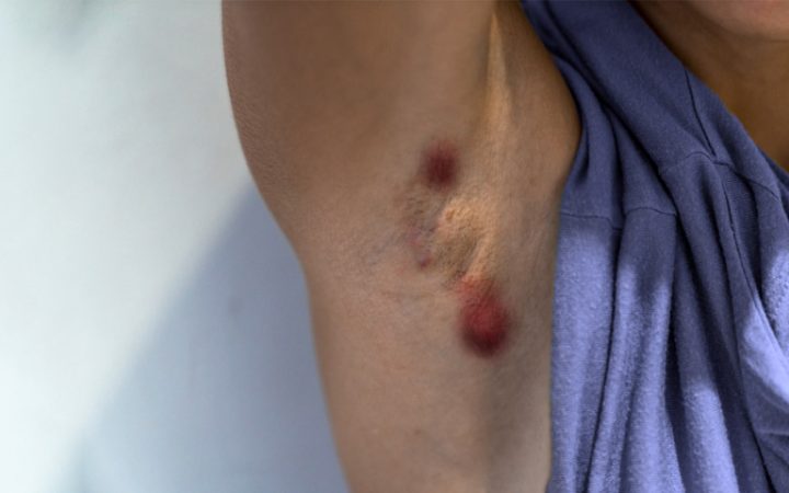 dolor de celulitis en la ingle dolor de celulitis en la ingle