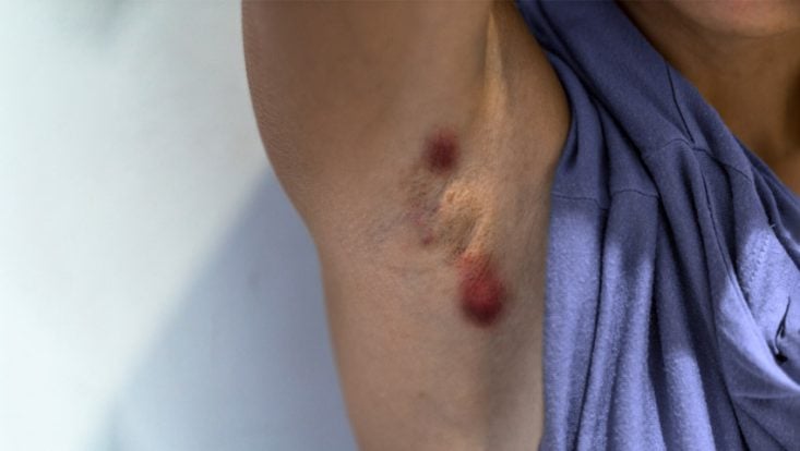 Hidradenitis supurativa: síntomas, causas y tratamiento