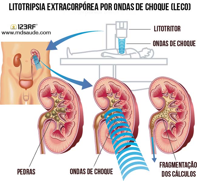 Litotripsia extracorpórea por ondas de choque (LECO)