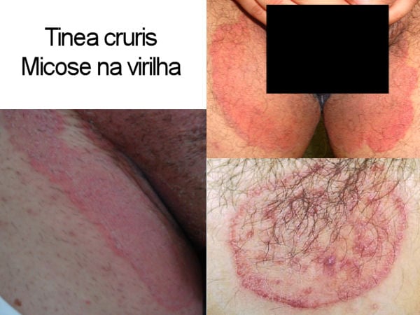 Micose na virilha (tinea cruris): sintomas e tratamento