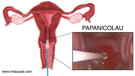 anormalidades papanicolaou