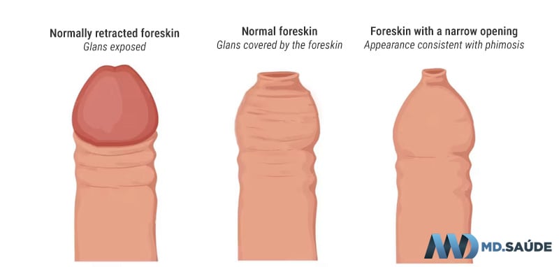 Schematic views of the foreskin during normal retraction, in its usual position, and with a narrow opening consistent with phimosis.