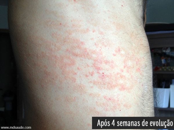 Pitiriasis rosada al cabo de un mes