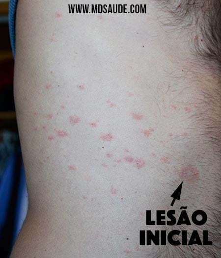 Pitiríase rósea - rash