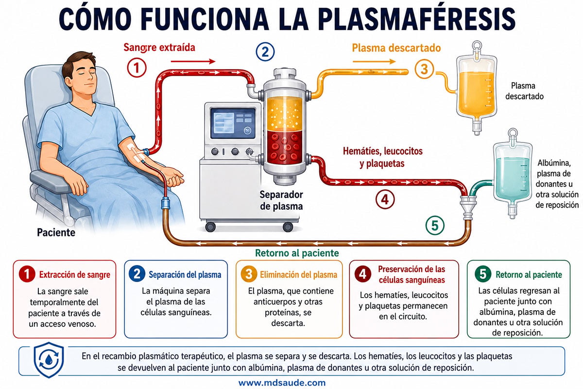 Cómo funciona la plasmaféresis