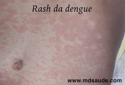 Manchas na pele da dengue